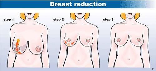 breast reduction surgery